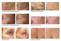 microneedling fotos